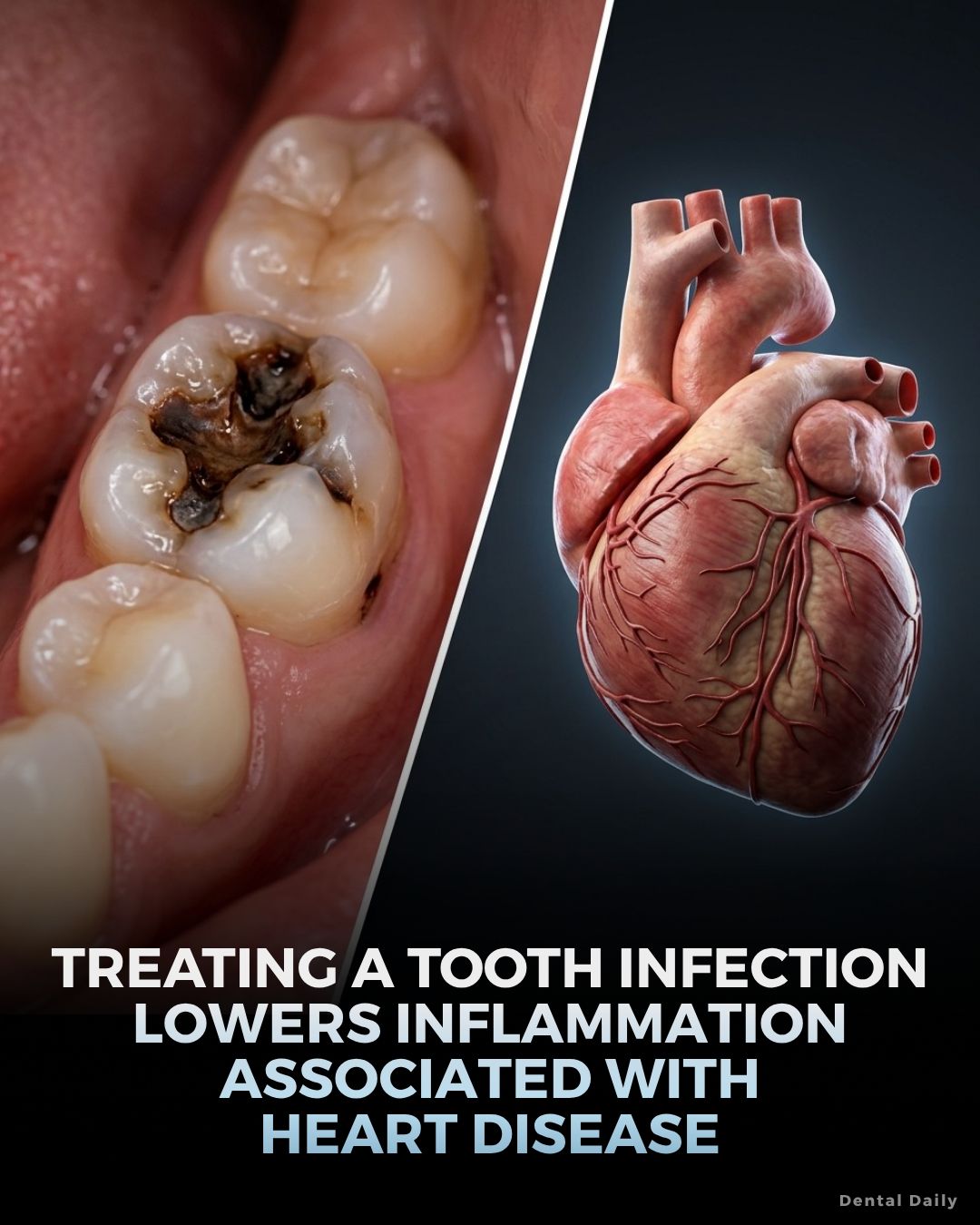 Yes, a dental infection CAN lead to sepsis! Infections can develop anywhere in your mouth, and a dental abscess can allow bacteria to reach deeper tissues. Protect your mouth, protect your health!