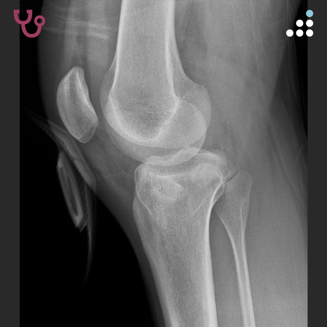 Orthobullets - Coronal CT of the same patient after surgical treatment ...