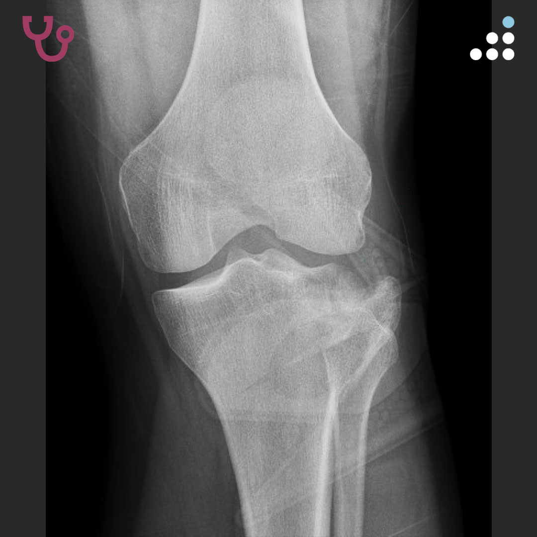 Orthobullets - Coronal CT of the same patient after surgical treatment ...