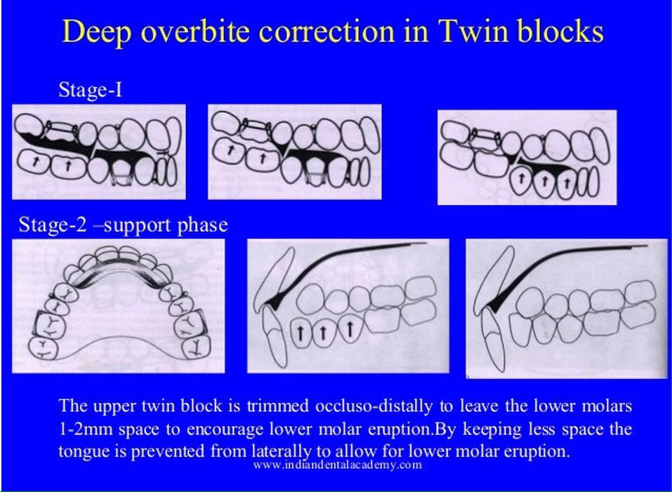 Orthodontics - Deep overbite correction in Twin blocks... | Facebook