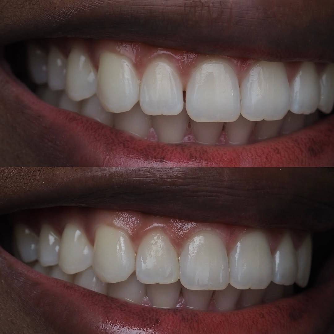 Tokuyama - “🤓 Spacing between teeth 🦷. Patient had ortho treatment 2 ...
