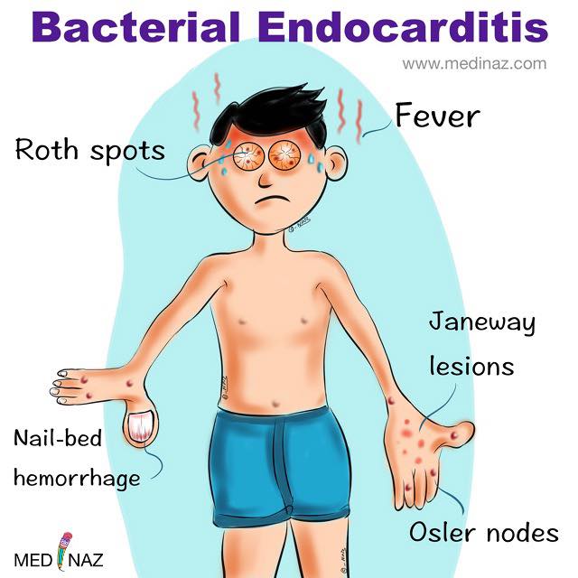 Medinaz - Bacterial endocarditis features | Facebook