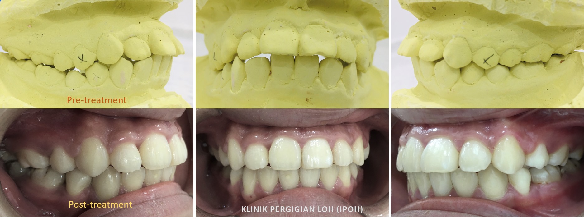 Loh Dental Clinic Klinik Pergigian Loh Posts Facebook