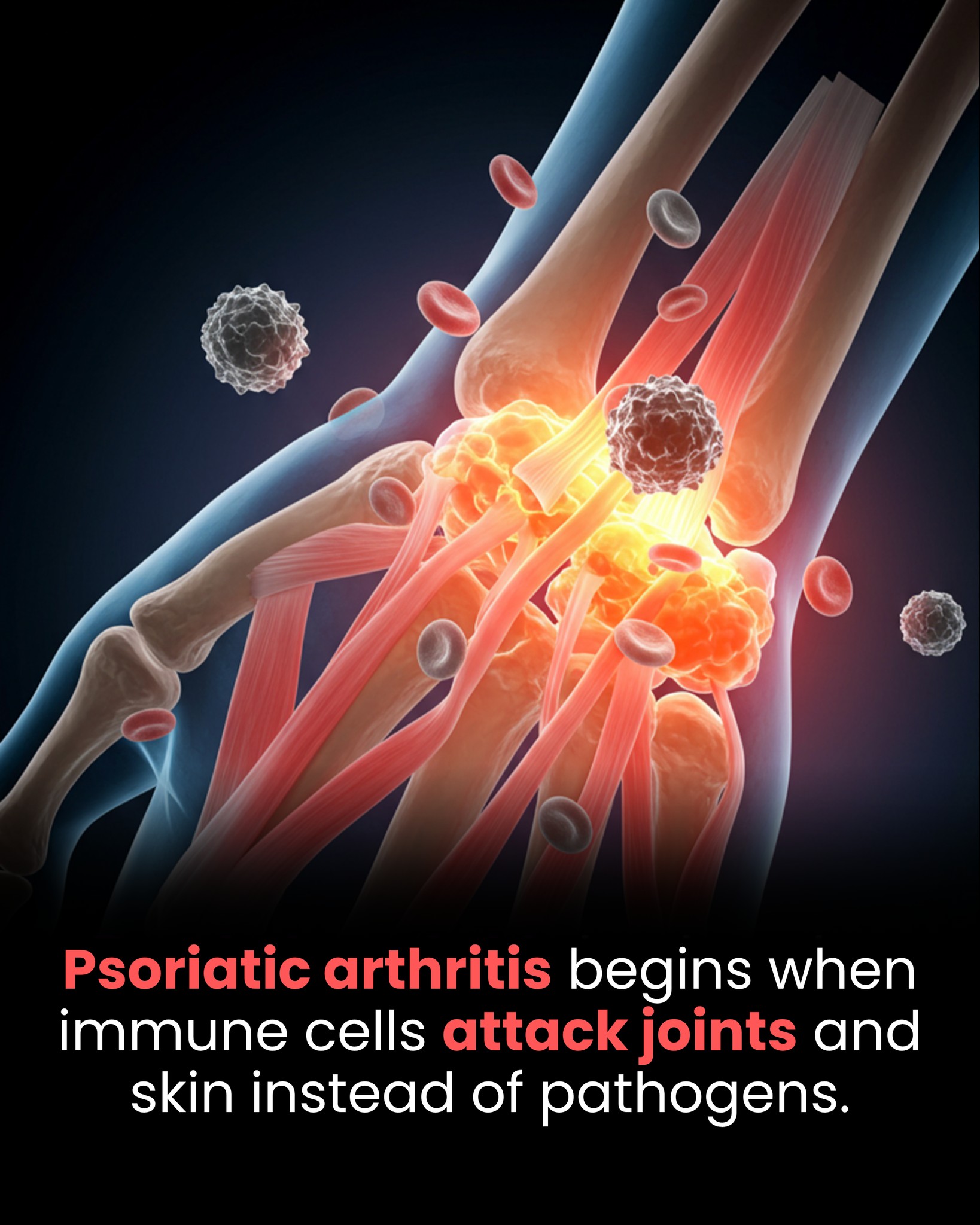 glutathione injections joint pain Psoriatic arthritis is a chronic inflammatory arthritis that affects up to 30% of people with psoriasis. While there's no cure, treatments can ease symptoms and prevent damage. Learn about risk factors Rejuvenate Austin | Med تونر قبل المرطب Select Syringe Size x Gauge x Needle Length:1cc x 31g x 5/16