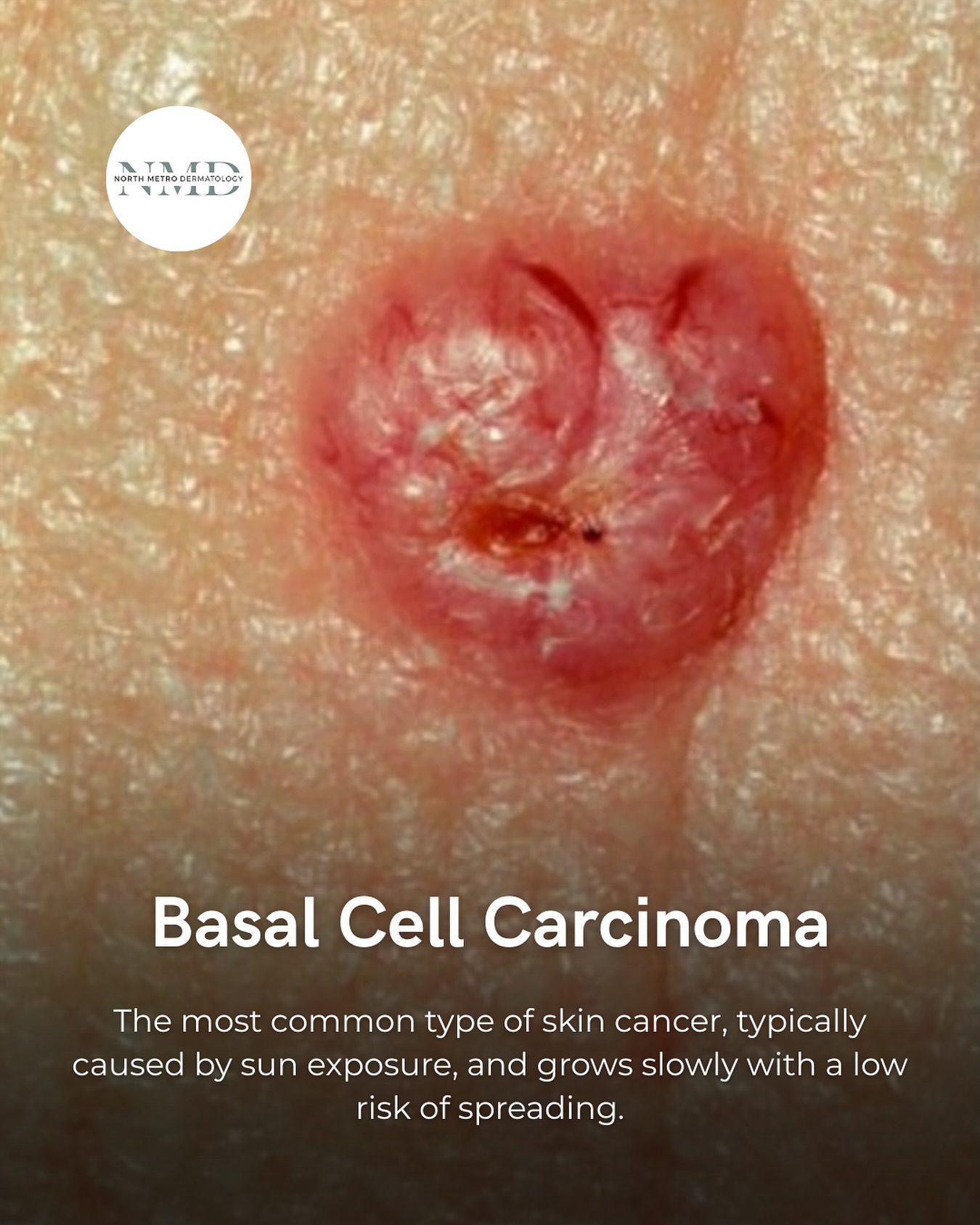North - Basal Cell Carcinoma (BCC) is the most common form of skin ...
