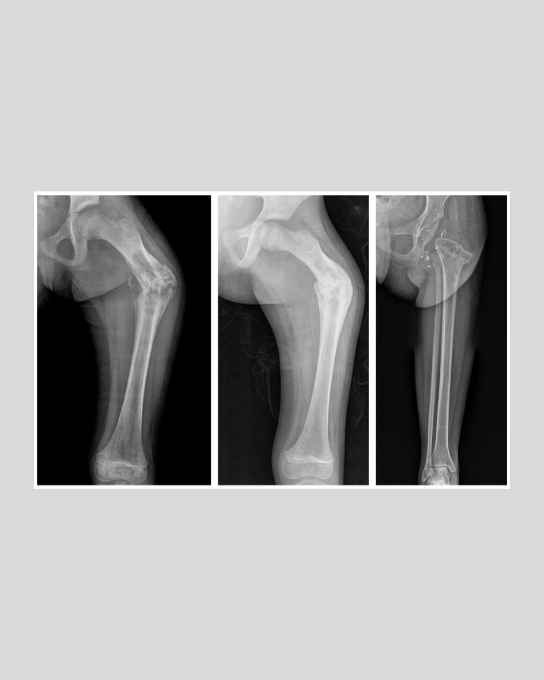 Type BIIIa rotationplasty... - The Bone & Joint Journal | Facebook