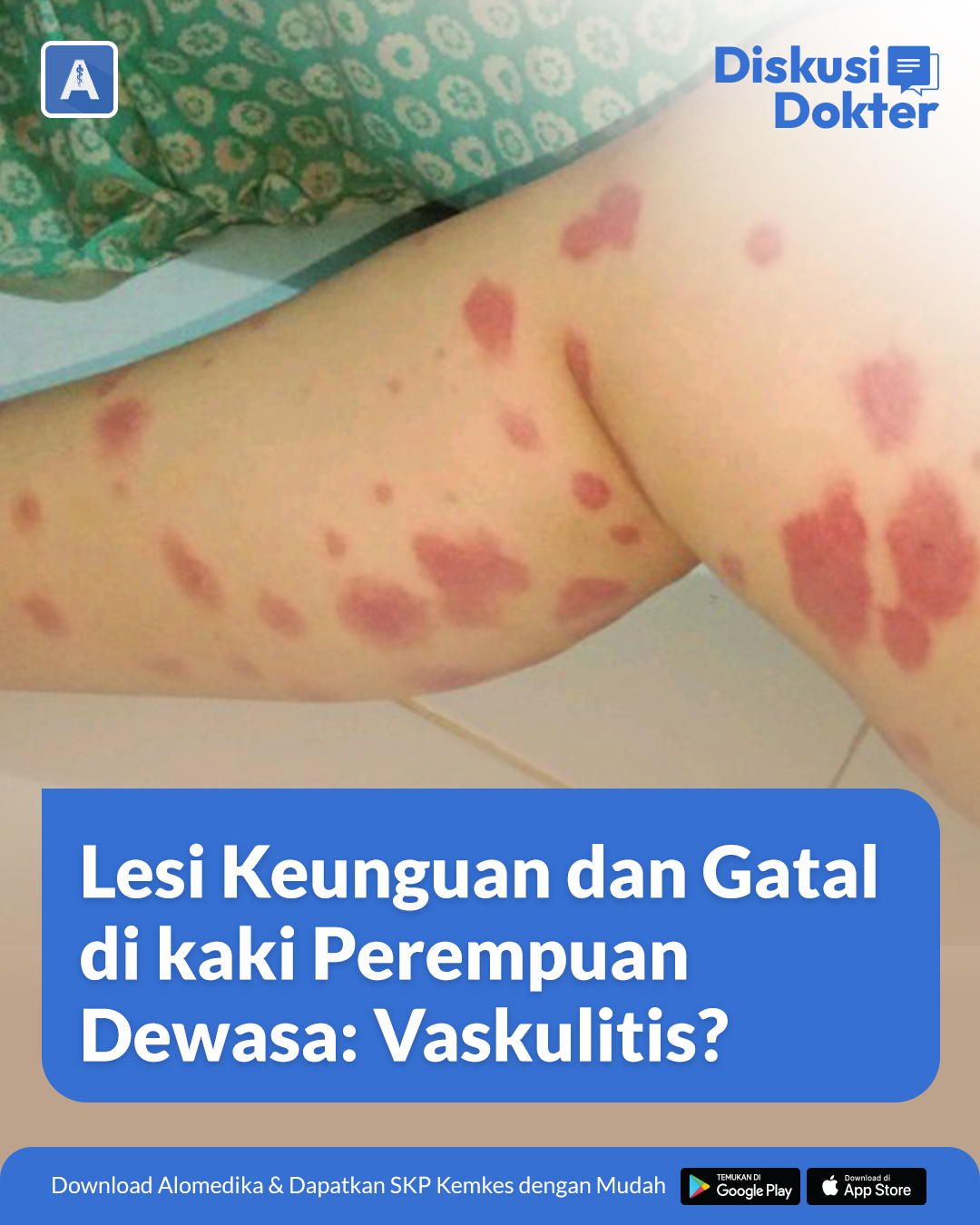 Alomedika - ALO Dokter! Melihat ruam merah keunguan di kaki pasien ...