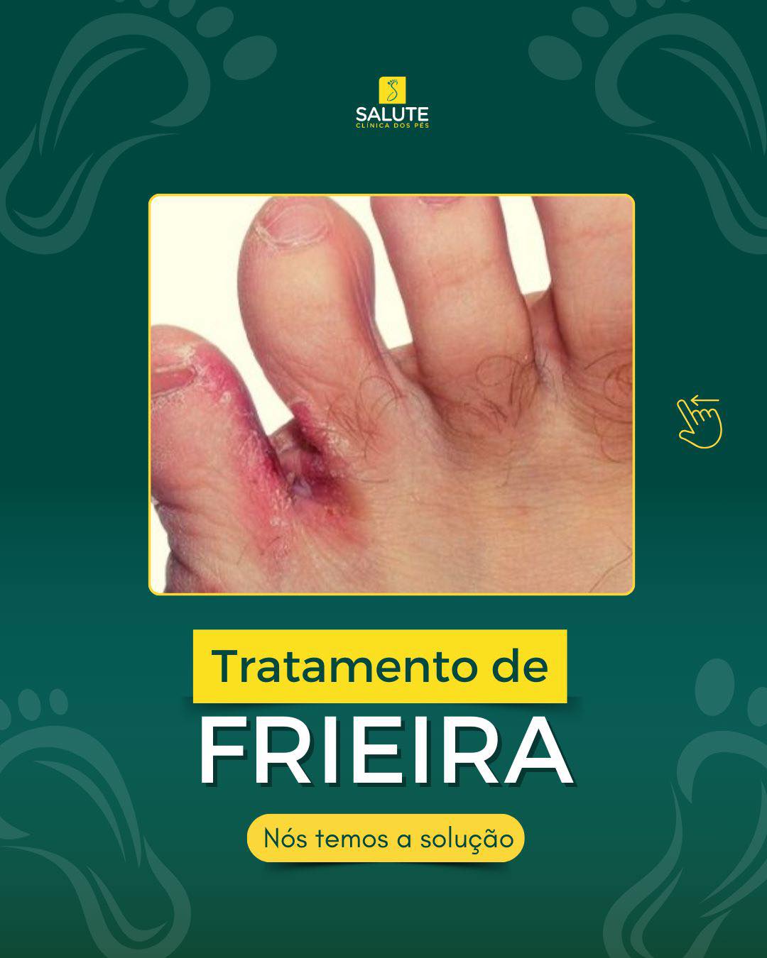 Podóloga Mari - Salute Clínica dos pés - A frieira é um tipo de micose ...