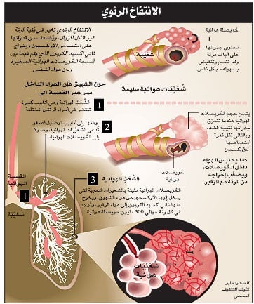 عيادة غندير لأمراض الصدر والحساسية إنتفاخ الرئة Emphyseme Pulmonaire يعني مصطلح انتفاخ الرئة وجود غاز في نسيج في مكان يخلو منه عادة انتفاخ الرئة هو مرض رئوي يتسبب في زيادة حجم