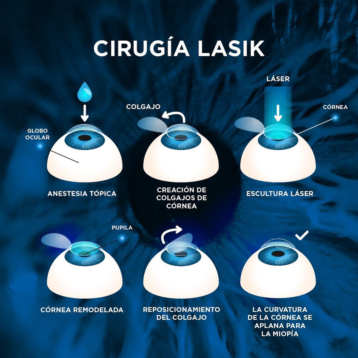 La CIRUGÍA LASIK es... - Unidad Oftalmológica de Tulancingo | Facebook
