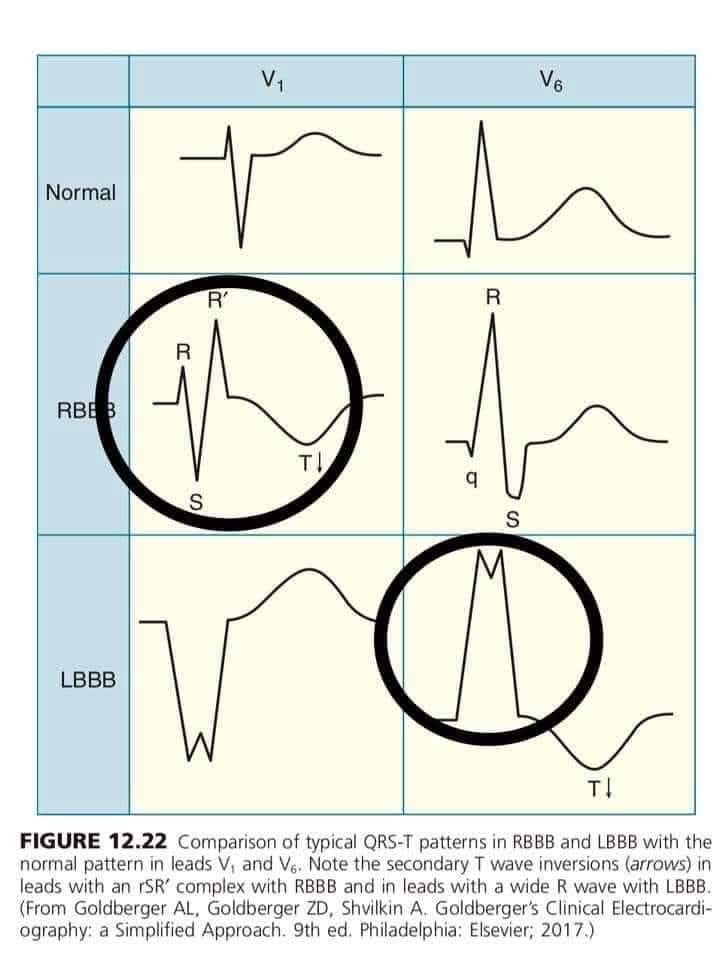 Cardiovascular - Comparison of typical QRS-T patterns in RBBB and LBBB ...