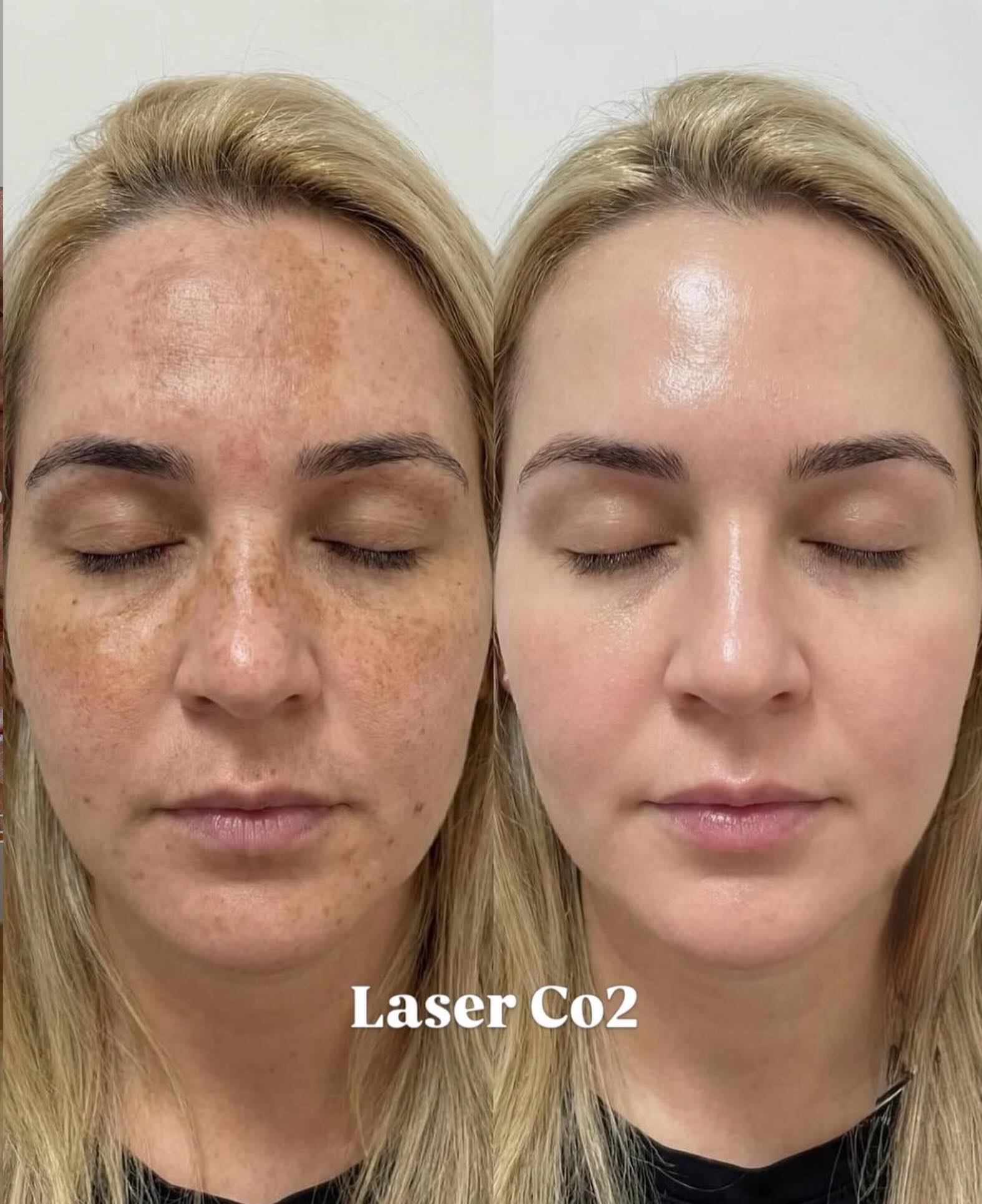 👀 Before & After CO2 Laser to target sun damage, wrinkles, and skin laxity. Make this the year you stop wasting money on 
