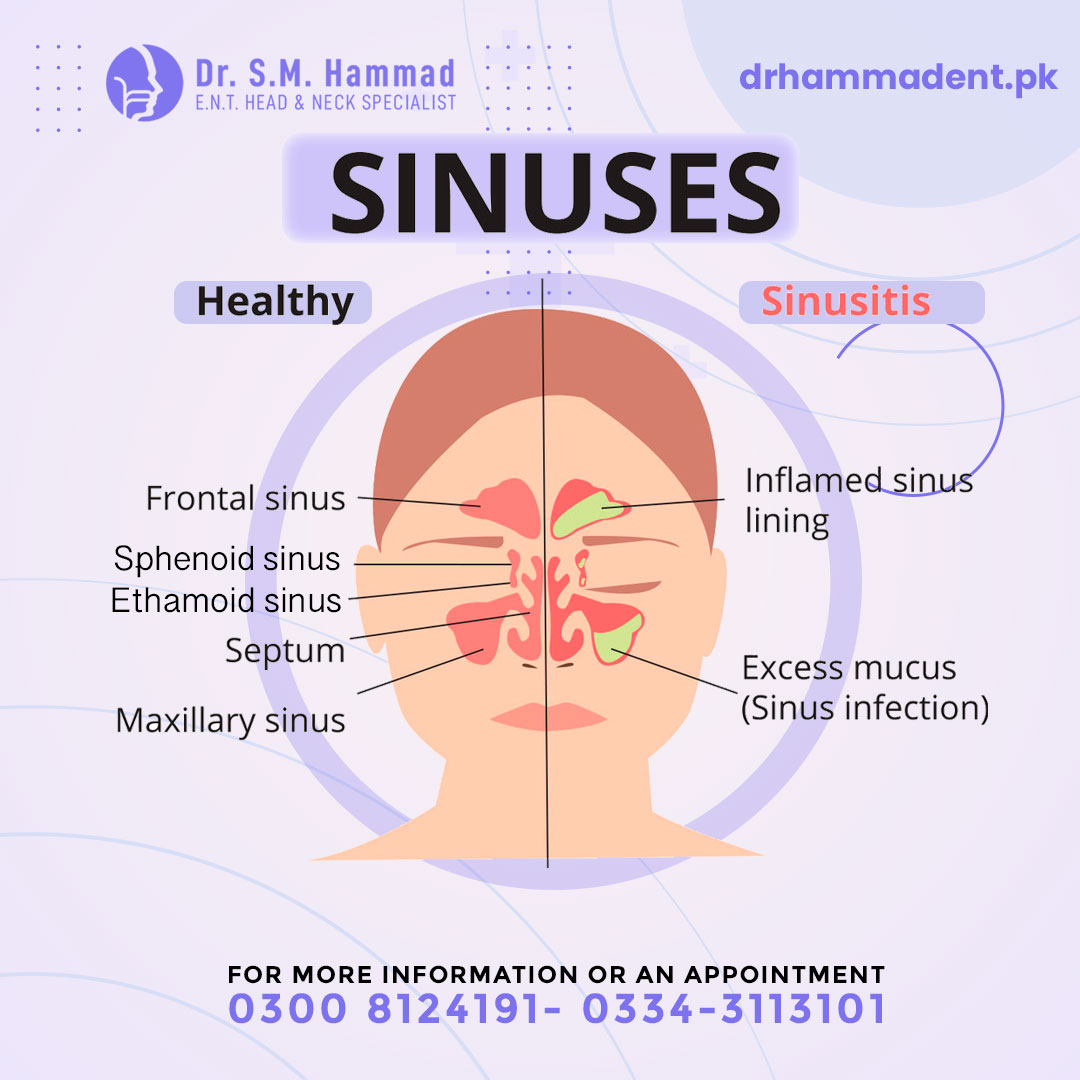 CHRONIC... - Dr. Hammad - ENT, Head & Neck Specialist | Facebook