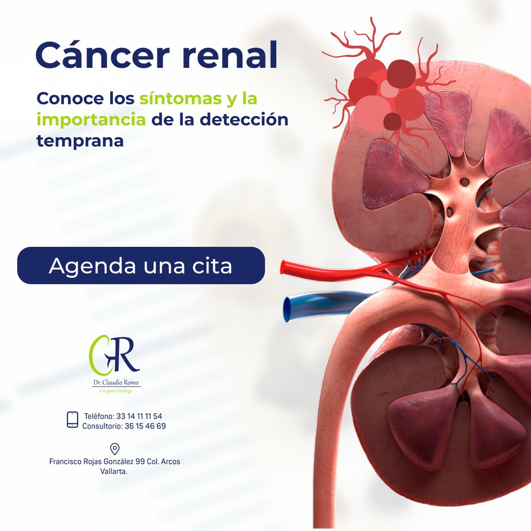 Dr. - El cáncer renal es un tipo de cáncer que comienza en los riñones ...