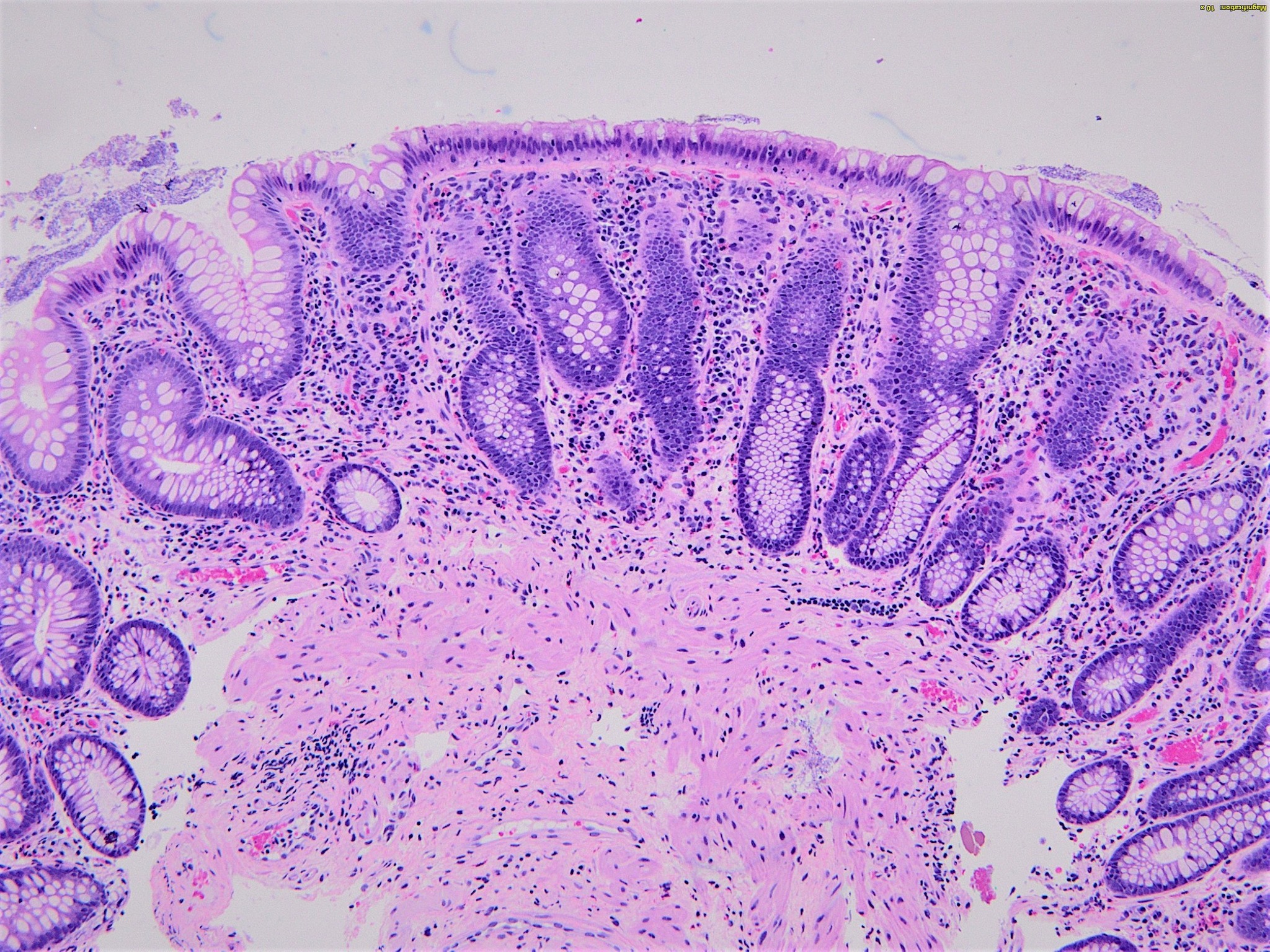 Normal colonoscopy with abnormal narrow band images in 76-year-old female