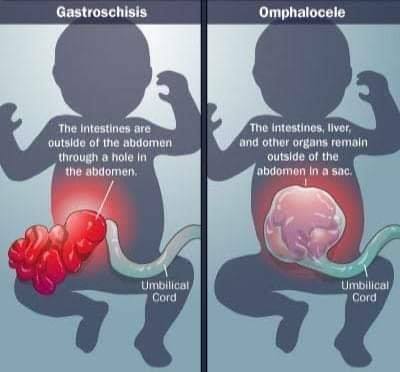 la-gastroschisis-et-l-omphaloc-le-sont-deux-anomalies-cong-nitales