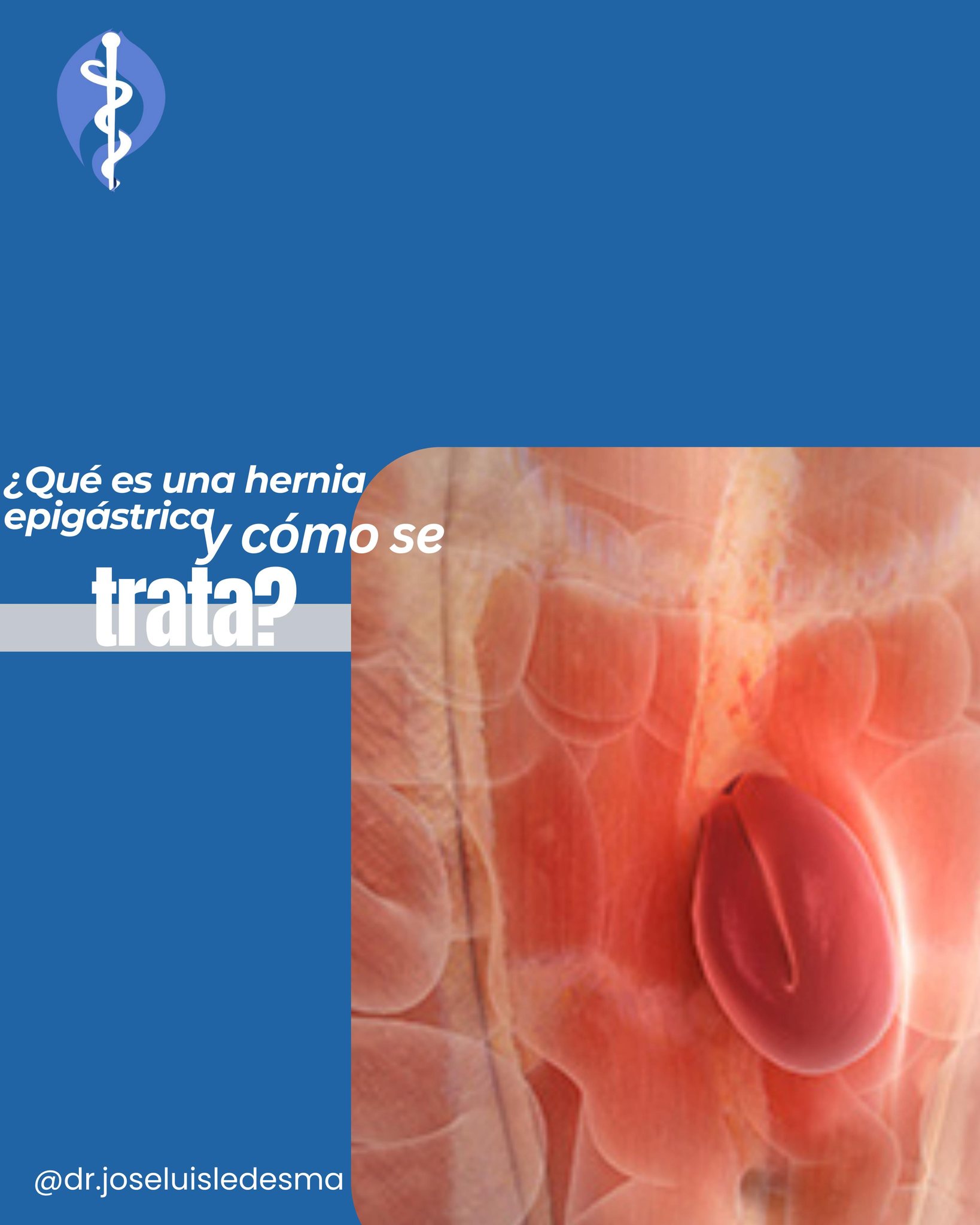 Dr. - ¿Qué es una hernia epigástrica y cómo se trata? ⚠️🩺 Una hernia ...