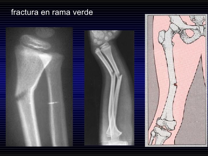 fractura-de-tallo-verde-rx-aprende-facil-facebook