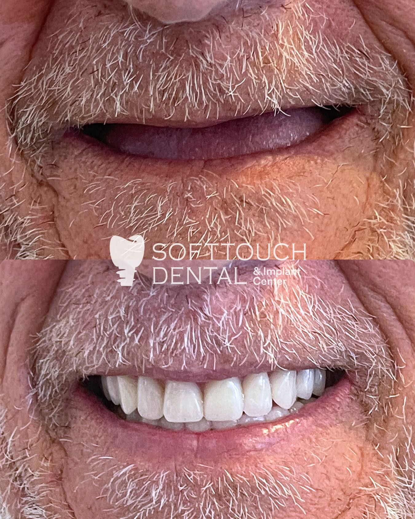 Softtouch Dental and Implant Center | Plano TX