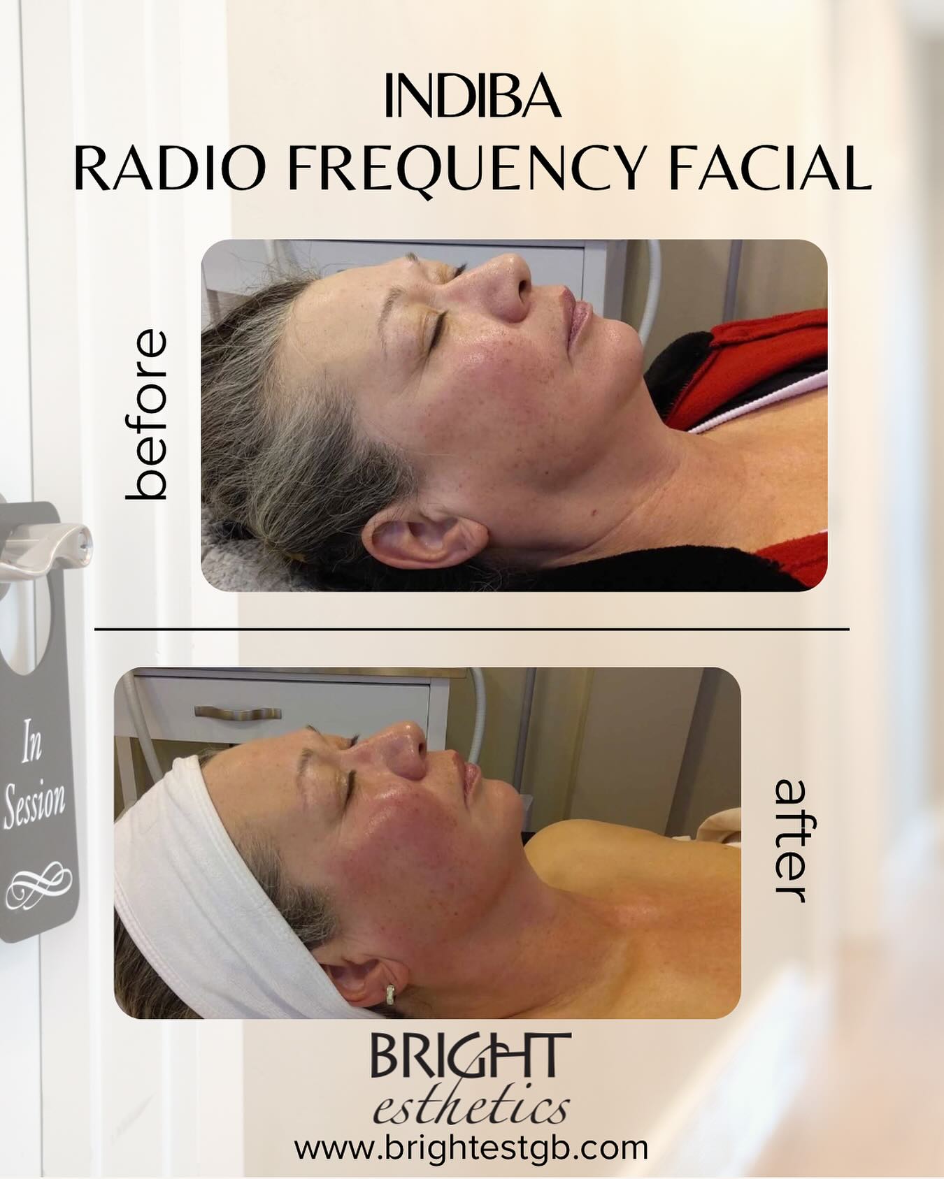 Before & After Glow No filters. No... - Bright Esthetics | Facebook
