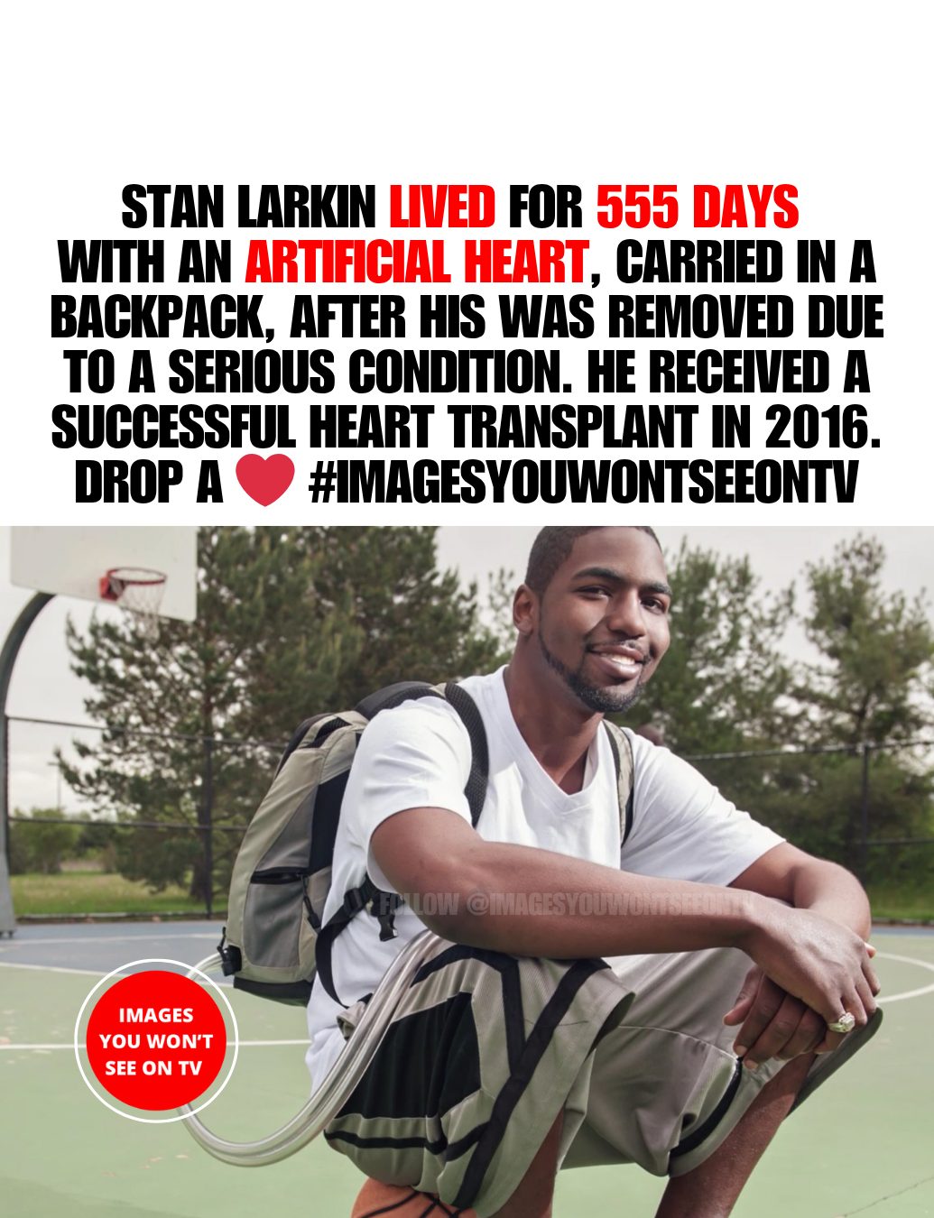 Images - Stan Larkin lived 555 days without a human heart, relying on a ...