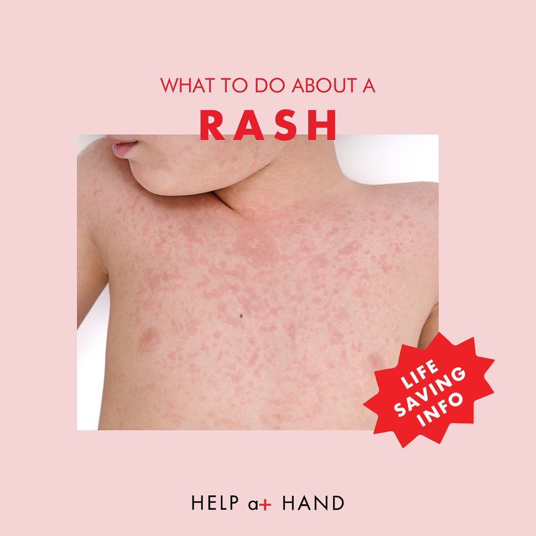A rash is very common in our... - Help at Hand Educuation