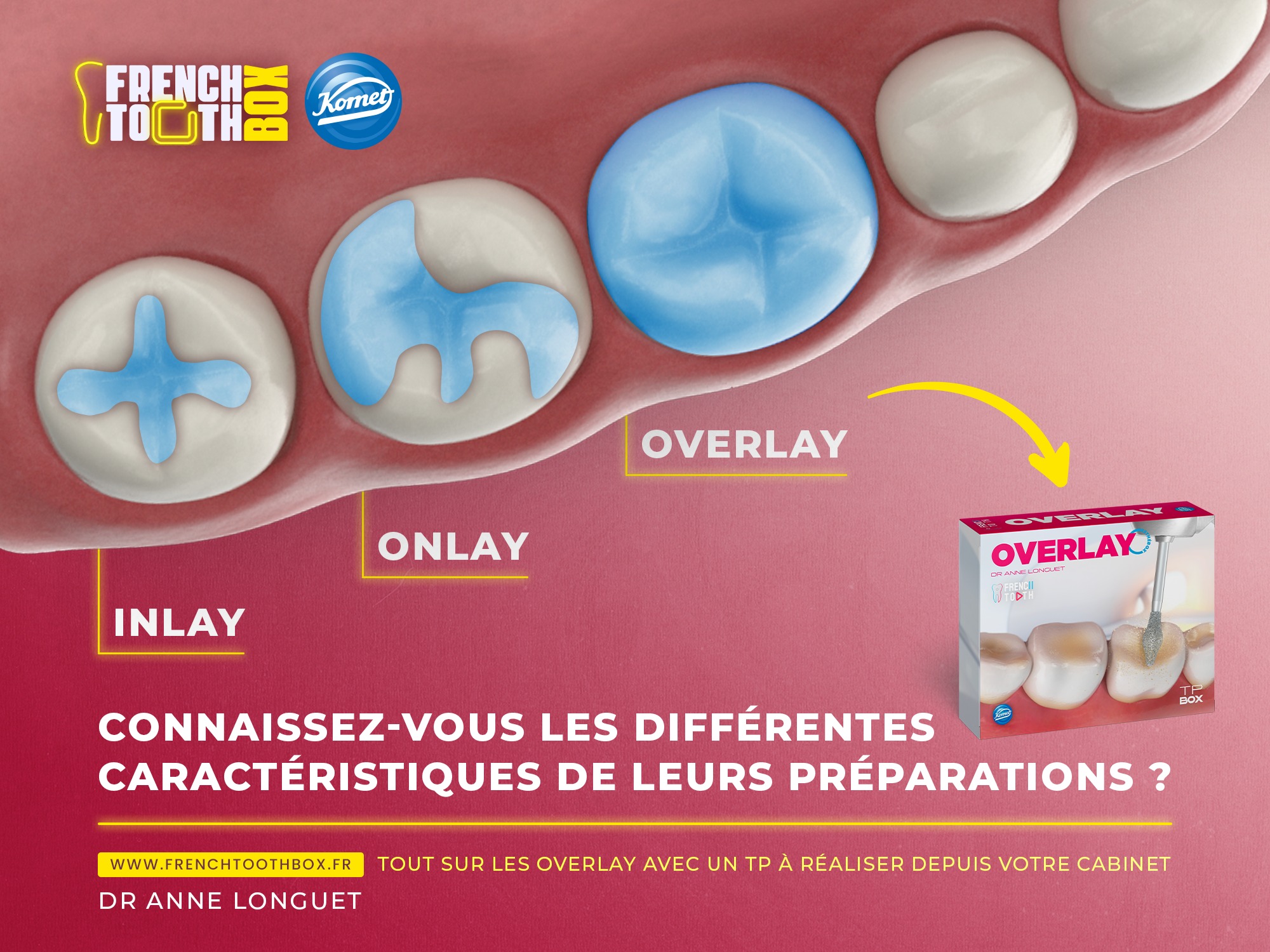 French Tooth - 🔎 L'inlay, l'onlay, et l'overlay... | Facebook
