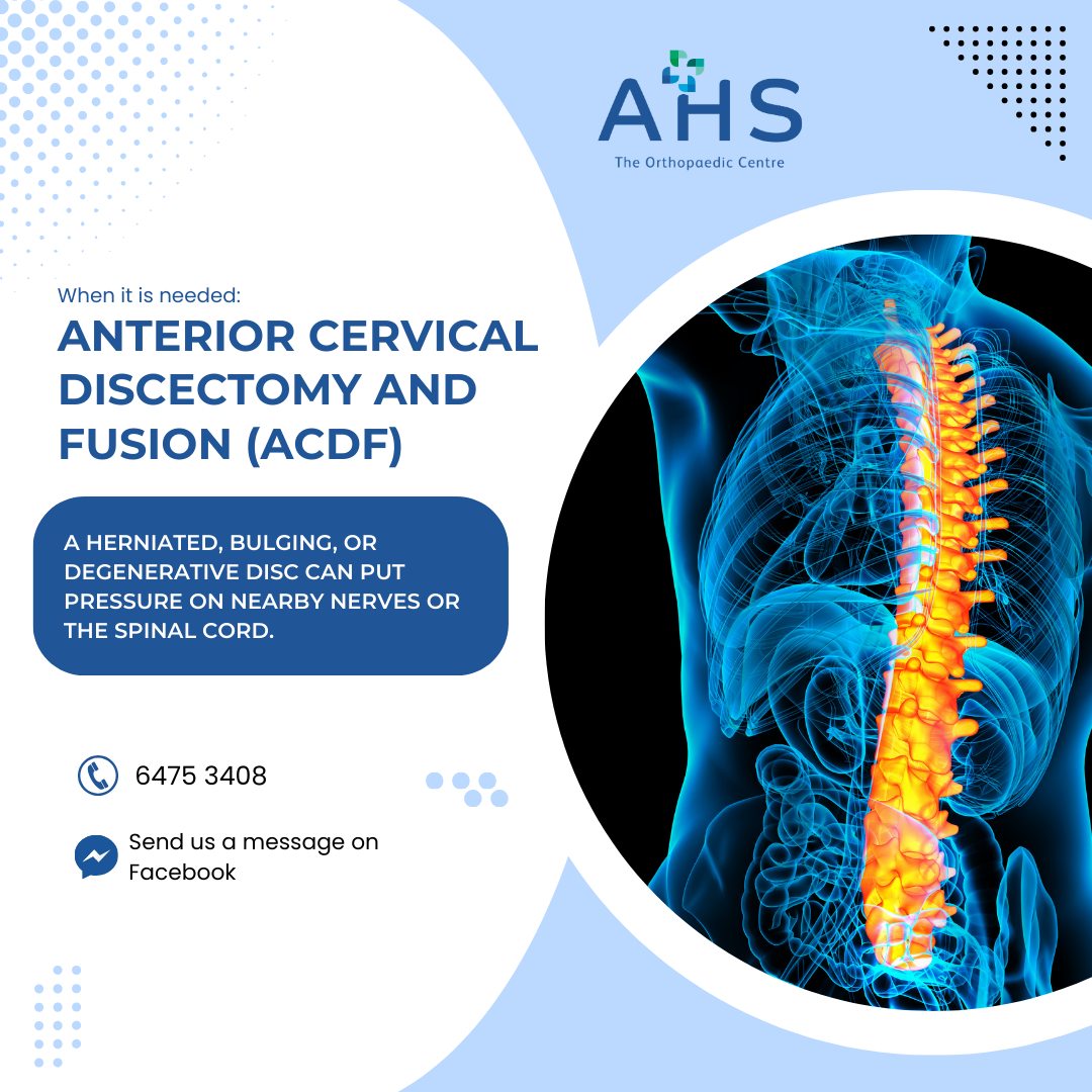 The Orthopaedic - ACDF: A Clear Path to Nerve Pain Relief Neck pain ...