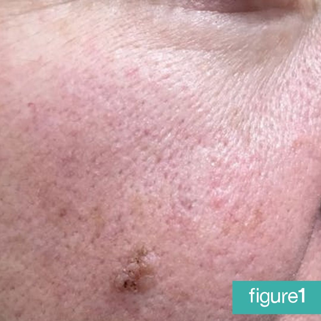 Figure - Is it just a Seborrheic Keratosis? 🔍A 50-year-old female ...