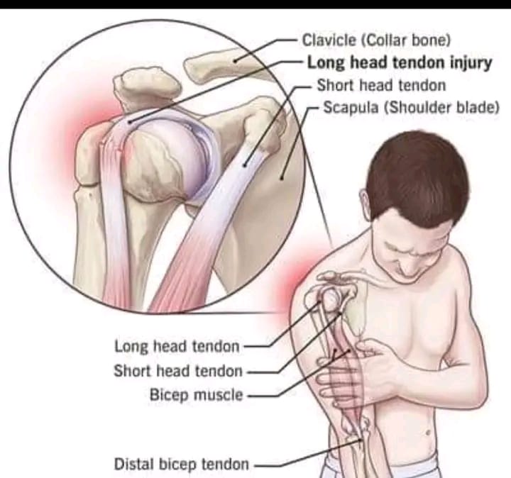 Biceps Tendon Injection