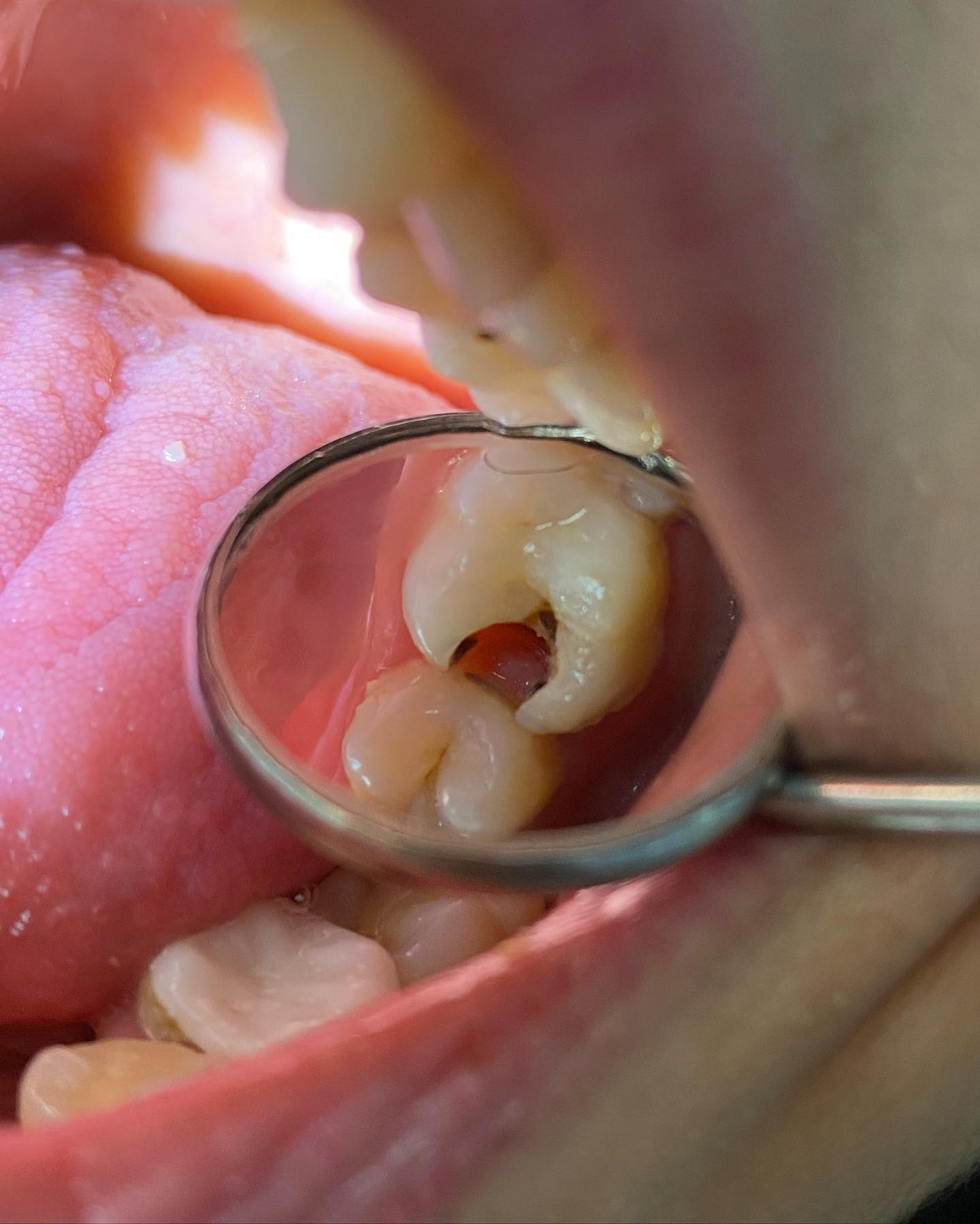 A before and after for a root canal... - Tooth Factory Clinic | Facebook