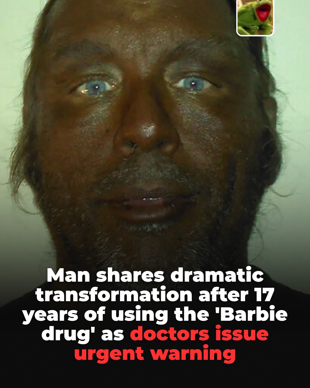 reddit melanotan A user has gone viral after sharing dramatic before-and-after photos documenting 17 years of using II, an unregulated synthetic substance known as the 