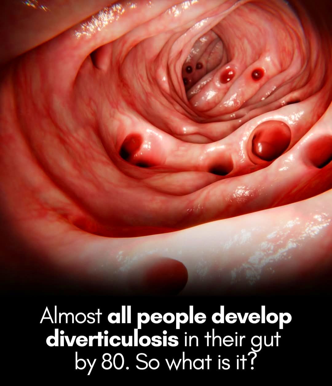 bpc 157 diverticulitis Can BPC-157 Fix Your Gut and Joints? Diverticulitis | New England Journal