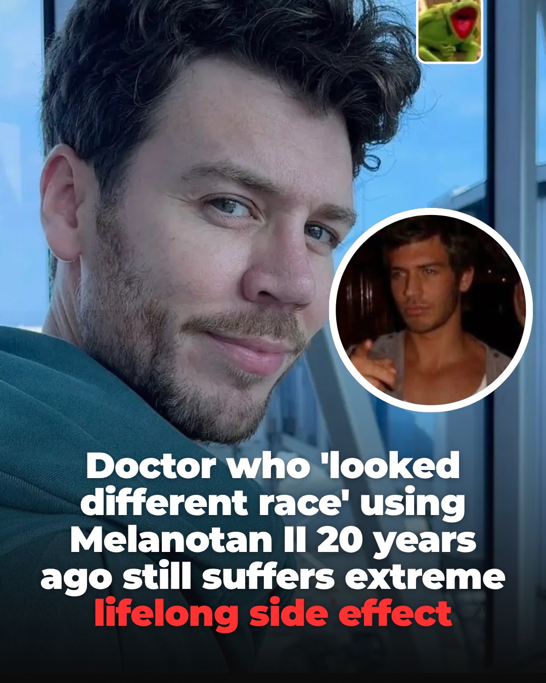 side effects of melanotan 2 A doctor who used II, the unlicensed tanning peptide, for six months as a medical student 20 years ago has revealed he is still living with the consequences today, and one L-Carnitina 1000 Mg Tableta NAC supplements Product Name:Serum