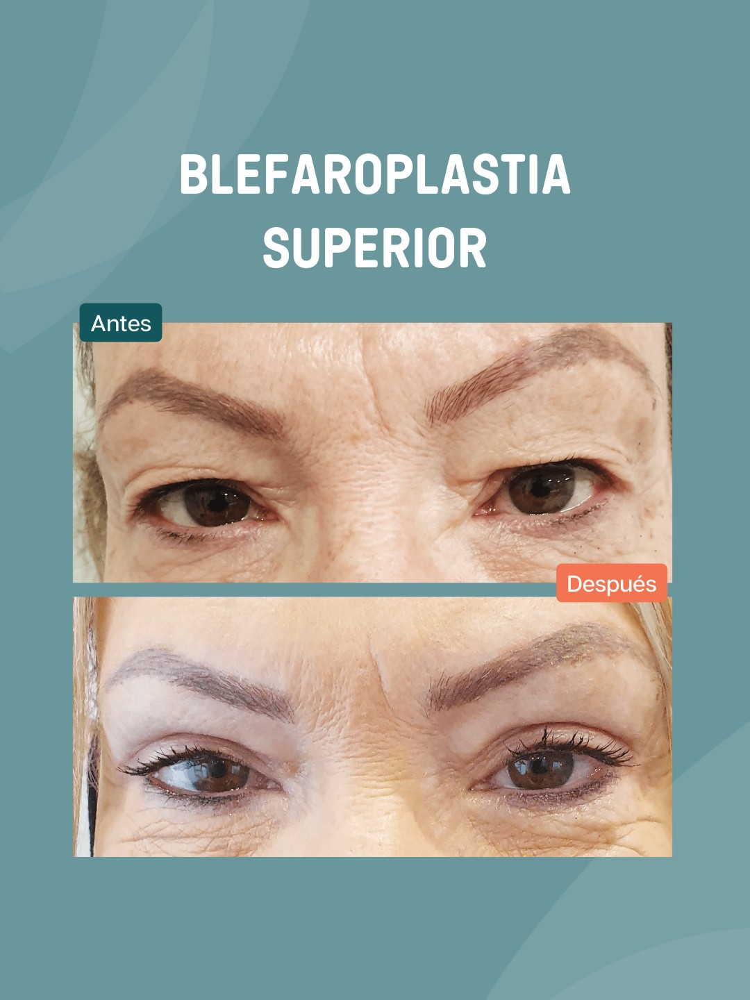 Así se ve una blefaroplastia superior después de 30 días... - Valverde ...