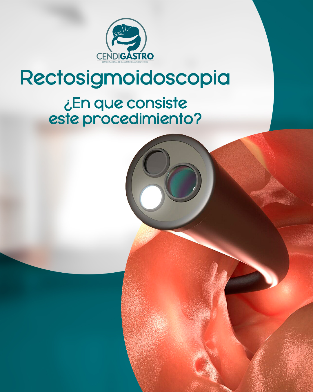 Rectosigmoidoscopia: Que Es, Para Que Sirve Y Como Se Realiza – JCDAT