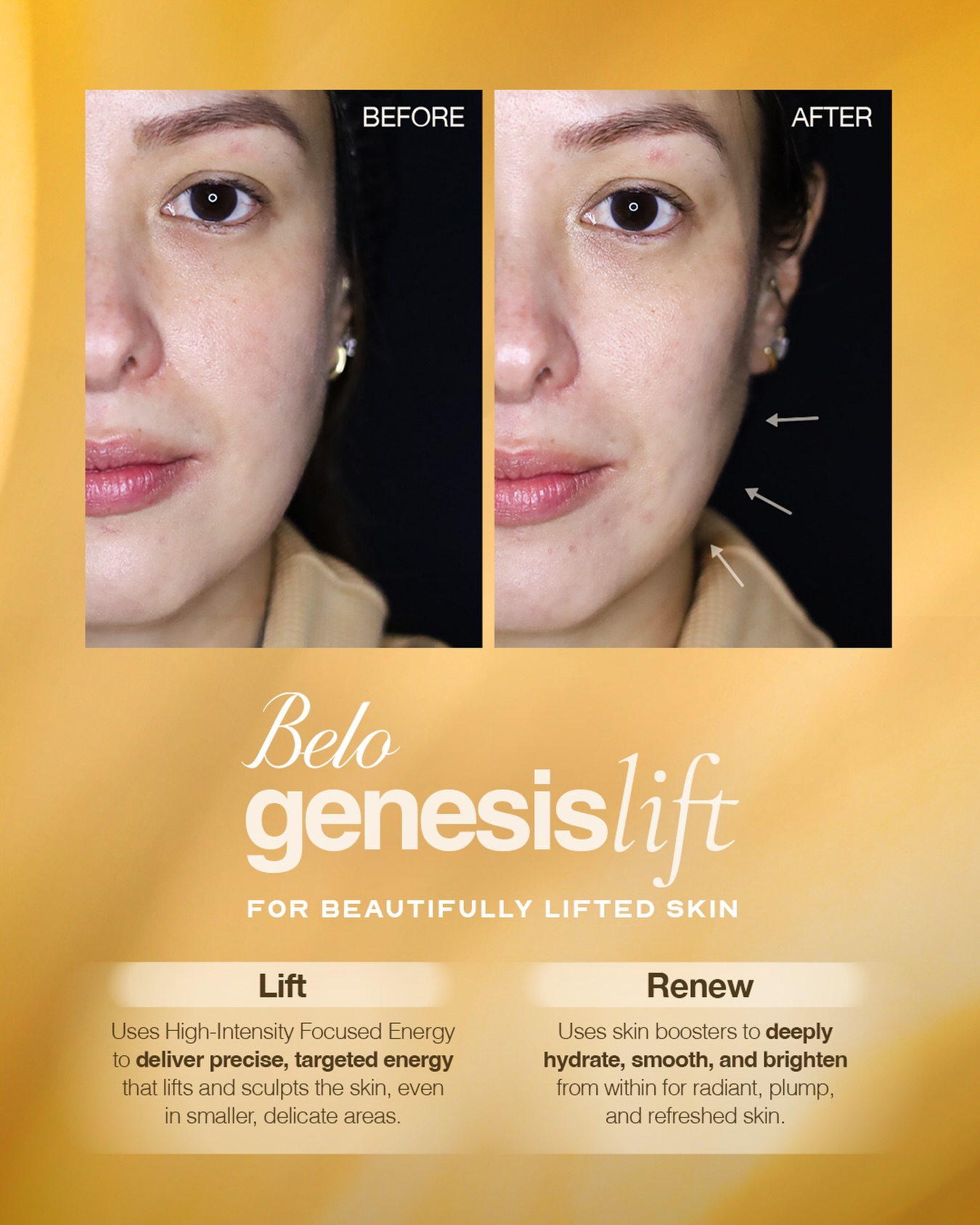 Achieve beautifully lifted skin in one treatment ✨ The Belo Genesis Lift combines precision targeting and skin renewal to lift, sculpt, and renew skin from within. Experience it for yourself! 💌 Send