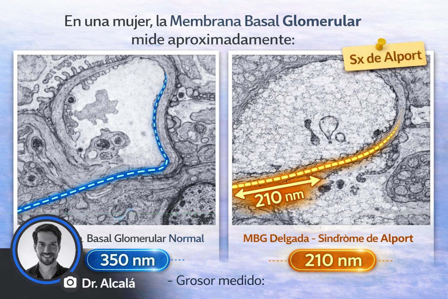 Dr. - 🧬 Síndrome de Alport: cuando la membrana basal glomerular es más ...