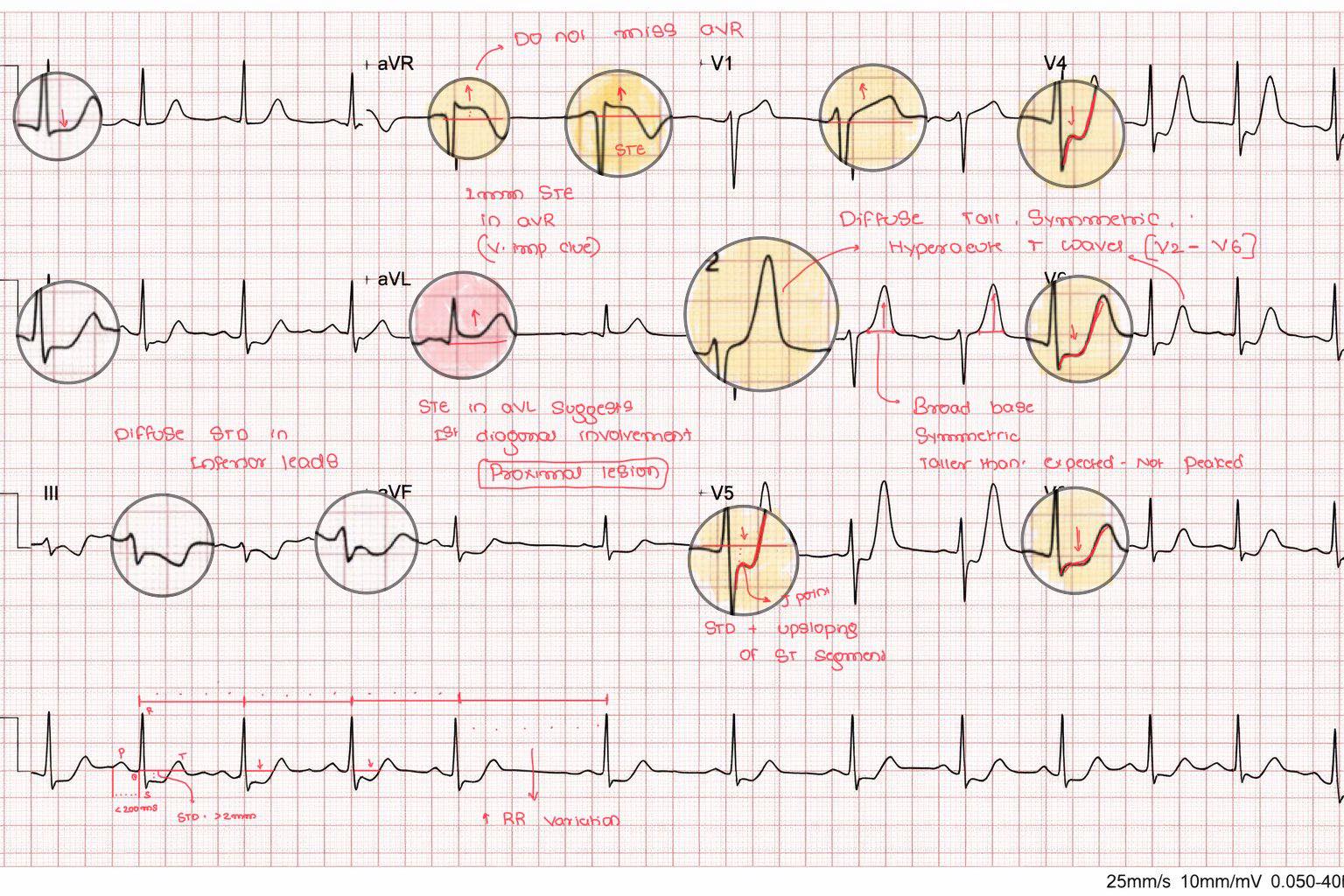 Cardiophilia - Breakdown of this ECG 🚨 De Winter Pattern = STEMI ...