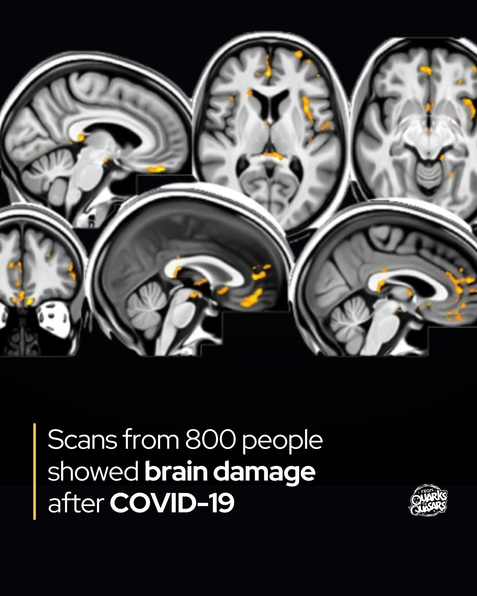 From - Even a mild case of COVID-19 can damage your brain. Researchers ...