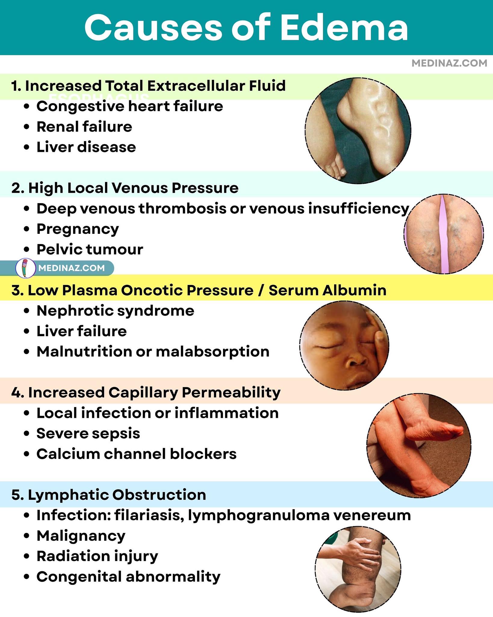 Medinaz - Causes of Edema | Facebook