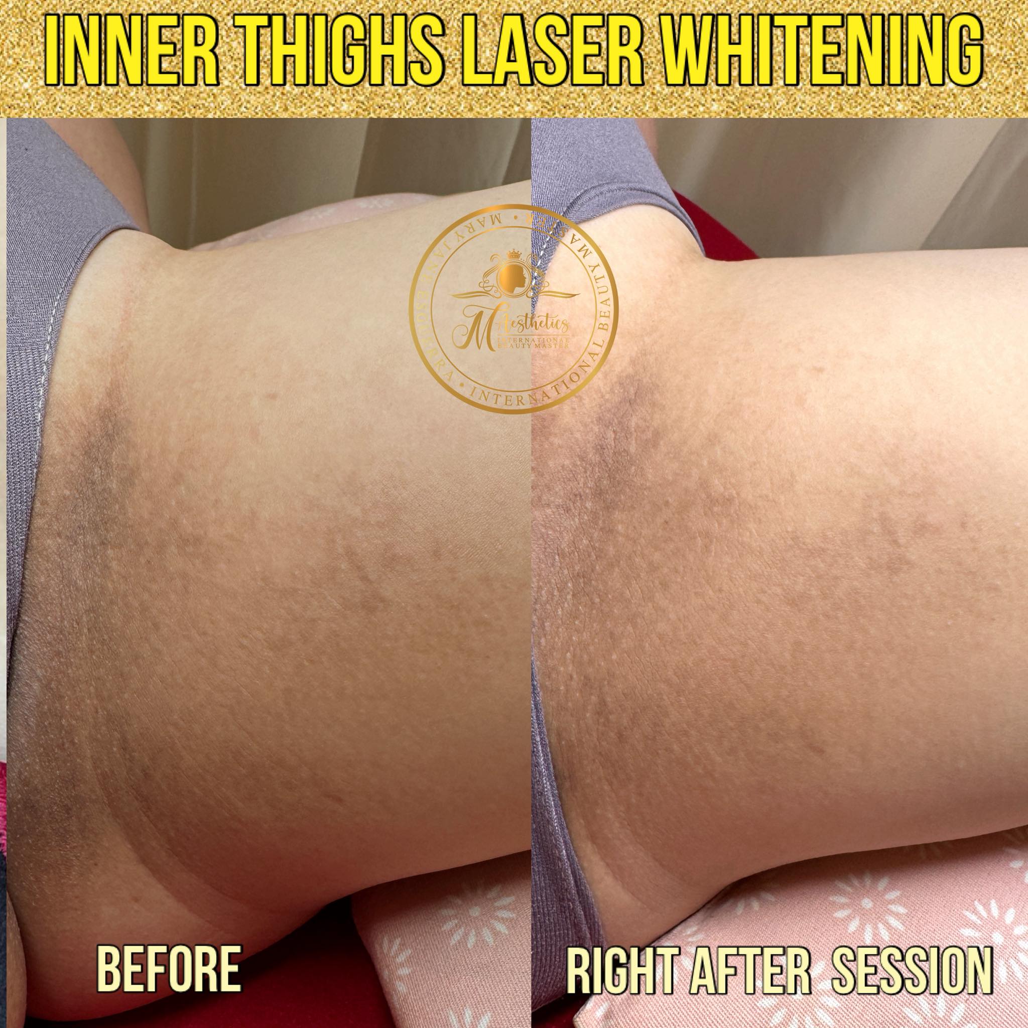 Struggling with dark inner thighs? This is what commitment looks like. Gradual, safe, and effective Inner Thighs Laser Whitening — results you can truly trust. Solution for Dark inner thighs and bikini