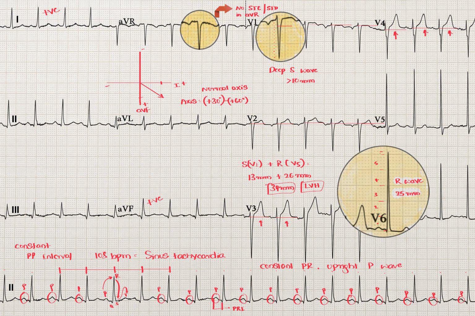 Cardiophilia - 🚨 Here’s the complete breakdown of this ECG case ...