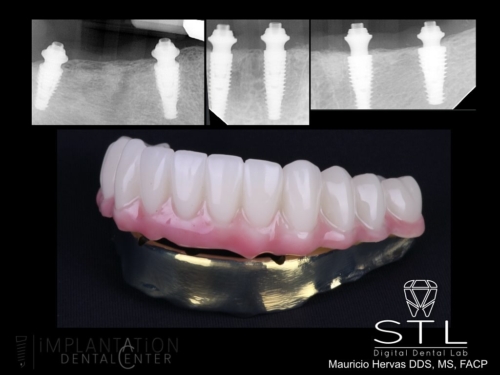 Implantation - Radiographic evaluation demonstrates fully ...