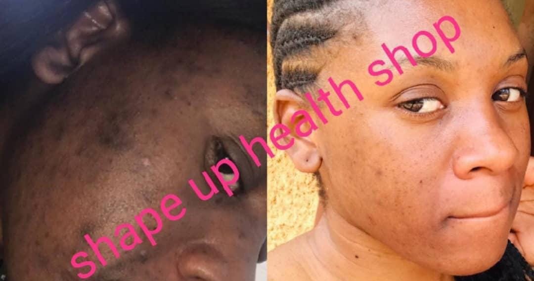 For those stubborn acne, pimples, dark spots and prevention of new breakouts trust our Organic Glutathione and kojic powder as it works effectively . we gat you covered visit our stores for