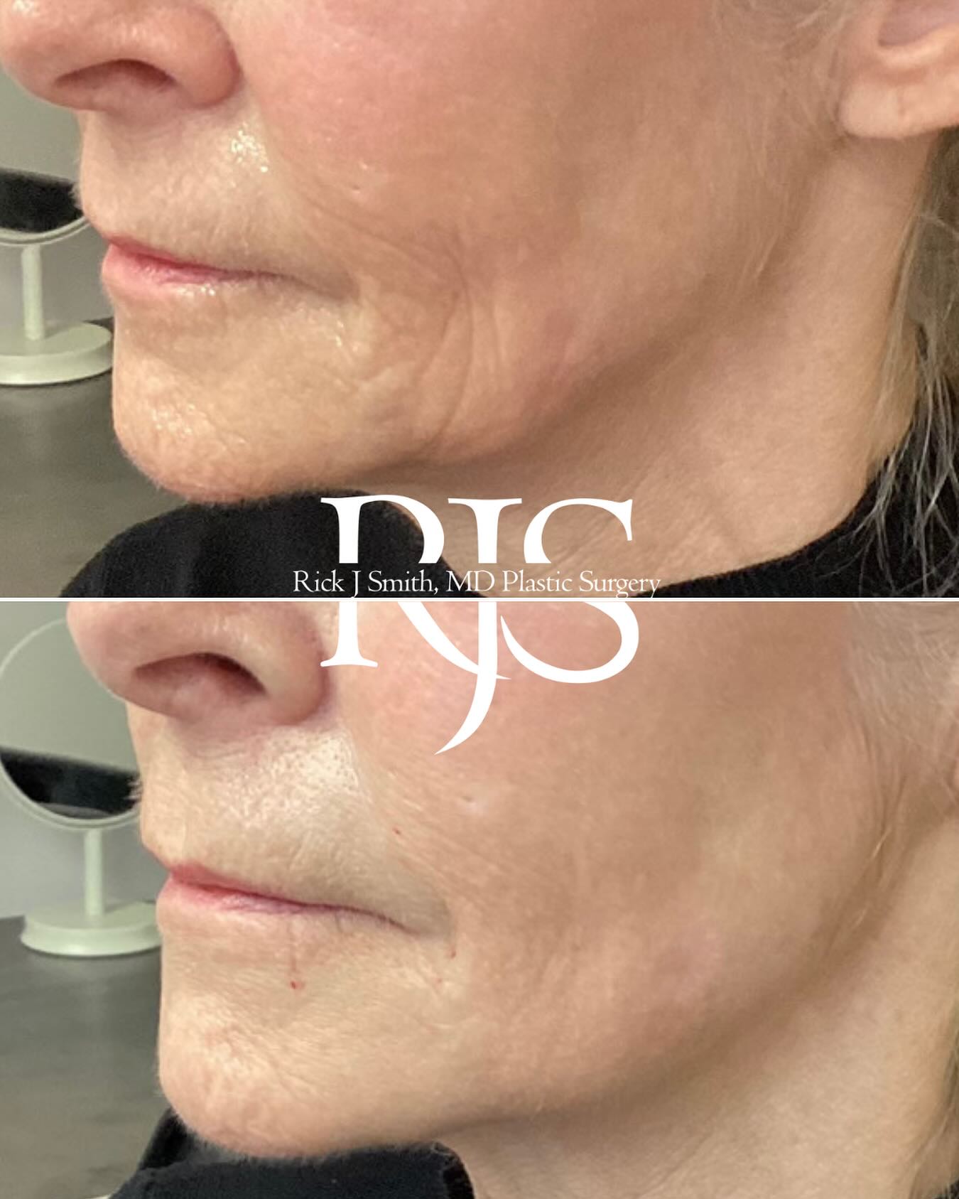 This before and after... - Rick J. Smith, MD Plastic Surgery | Facebook