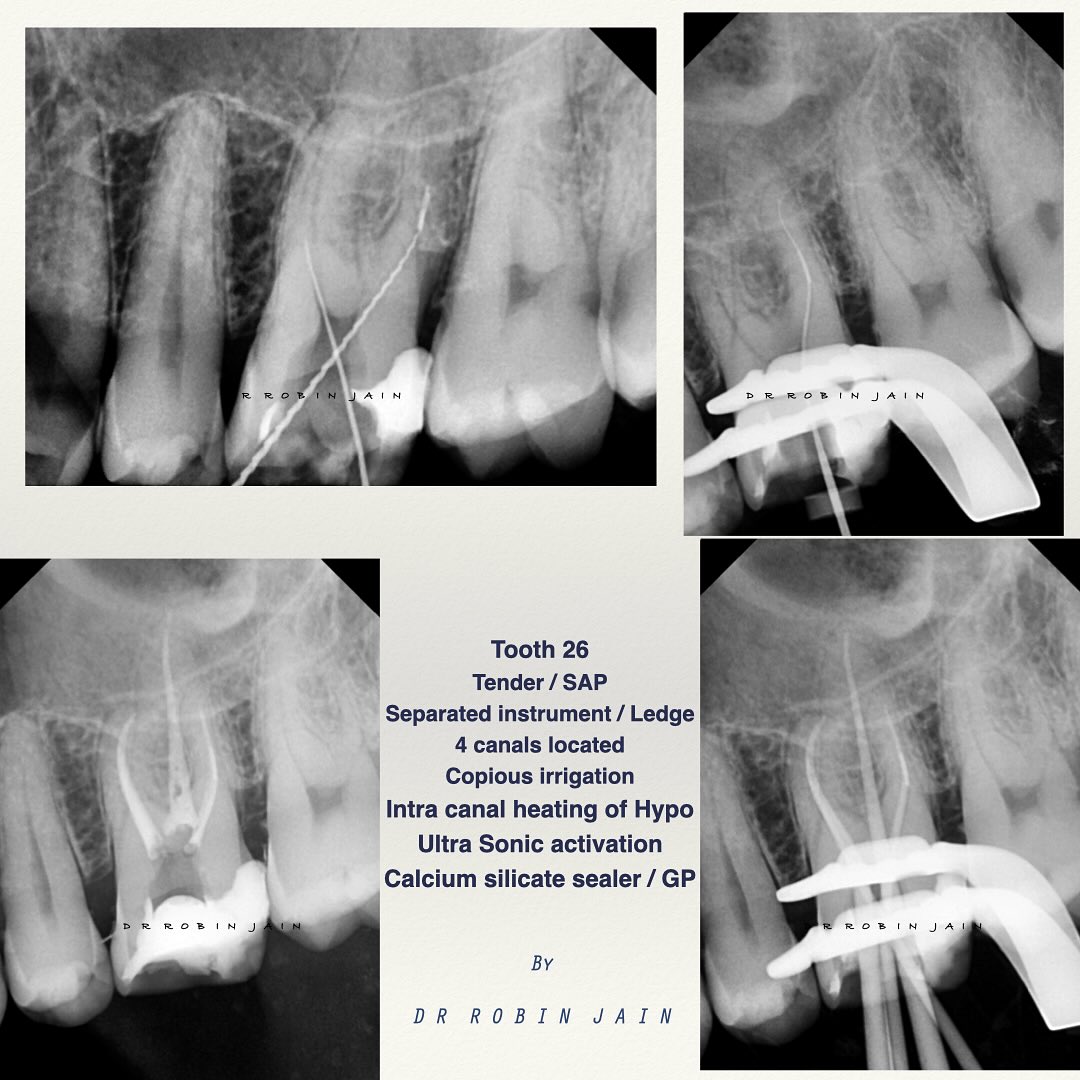 Dr. Robin Jain - Endodontist - Tooth 46 Symptomatic Apical ...