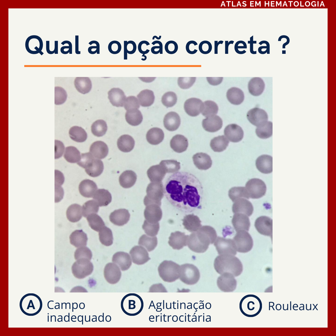 Qual a correta? #biomedicina... - Atlas em Hematologia | Facebook