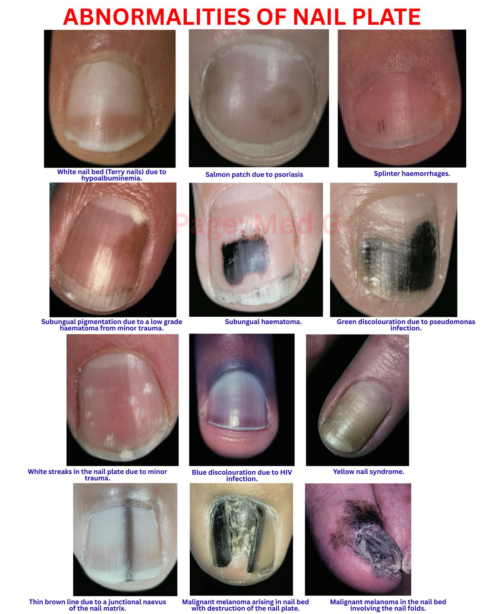 Med G - Abnormalities of nail plate . . . . #nail #problem... | Facebook