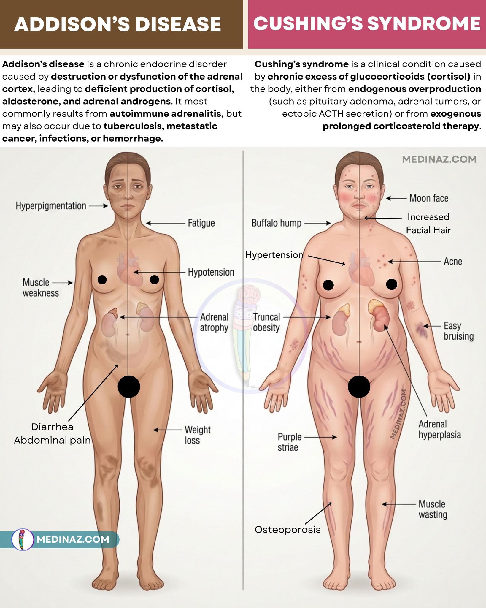 Medinaz - Addison's disease Vs Cushing's syndrome: Important differentiating points ⬇️